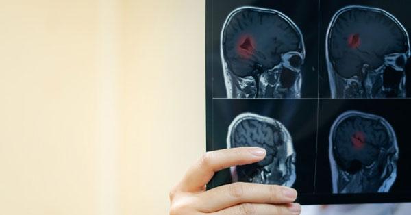 A stroke, vagyis a stroke események, ritkán előforduló okai közé tartoznak bizonyos egészségügyi állapotok és környezeti tényezők, amelyek nem annyira ismertek, mint a hagyományos kockázati tényezők. Ilyen például a véralvadási zavarok, a szívritmuszavaro